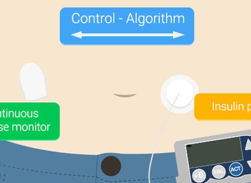 pancreas artificiale